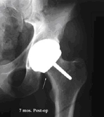 Imagen: El Sistema de Revestimiento de Cadera Total Conserve Plus. Foto cortesía de  Wright Medica